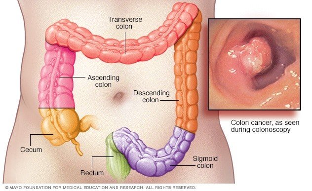 Best Colon cancer treatment in India