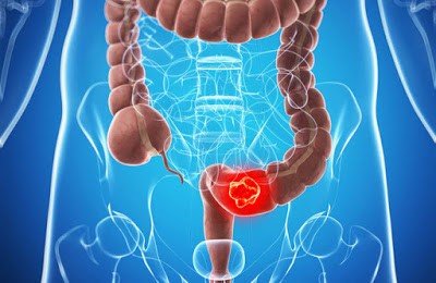 colorectal cancer