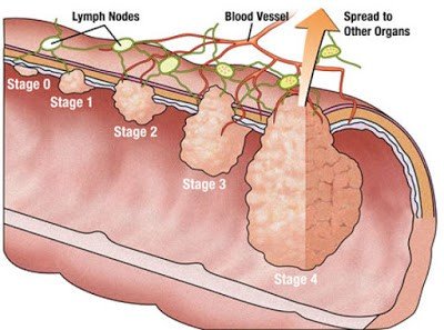 Colorectal Cancer