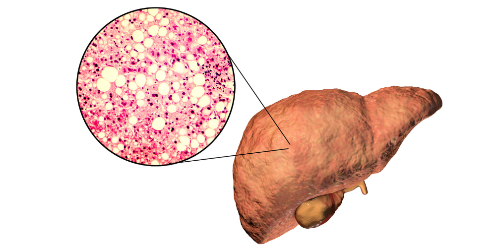 Fatty Liver Disease Fatty Liver Disease treatment in India