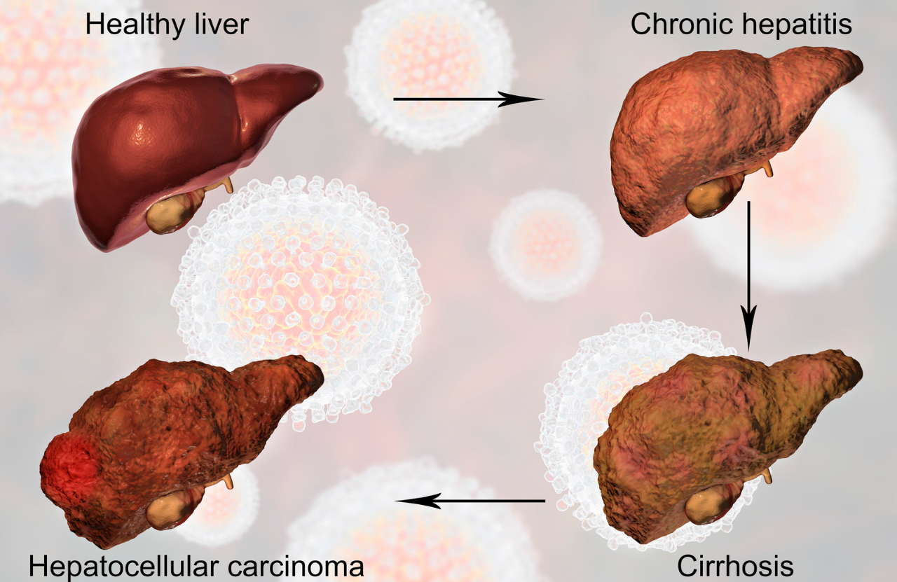Understanding Fatty Liver Disease Understanding Fatty Liver Disease