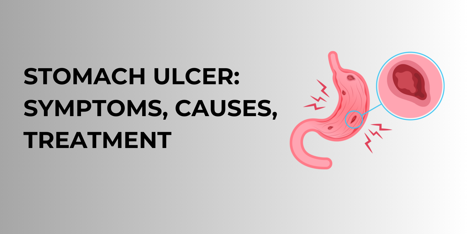 Gastro Blog Banner Stomach Ulcer