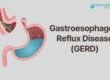 Best GERD Treatment in Gurgaon