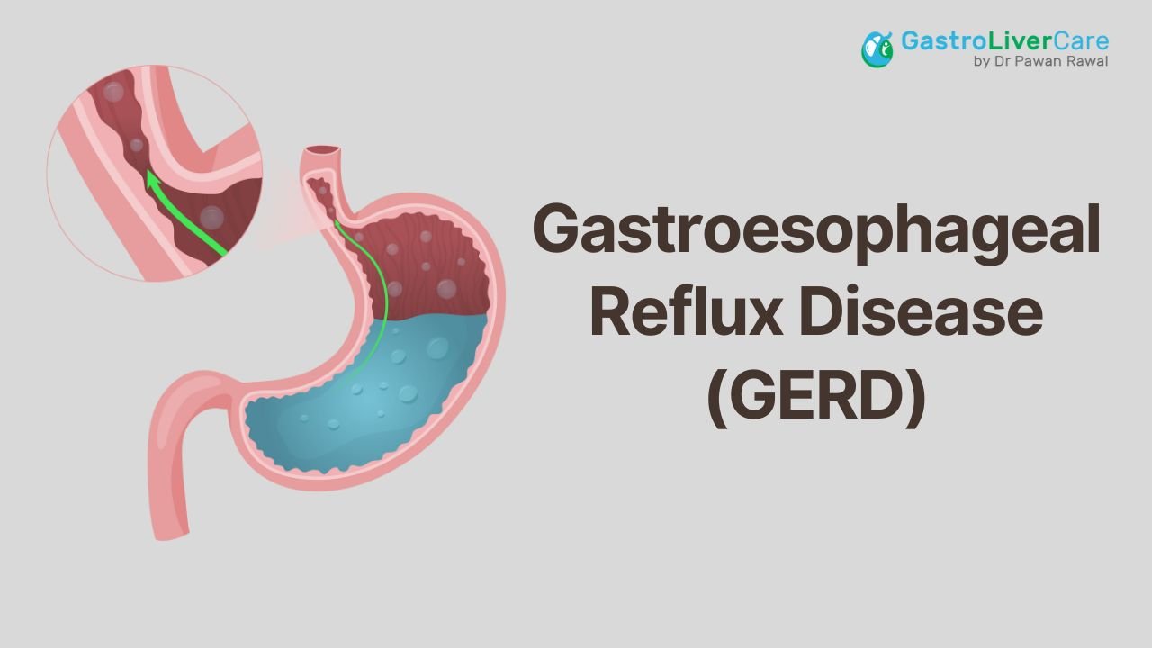 Best GERD Treatment in Gurgaon