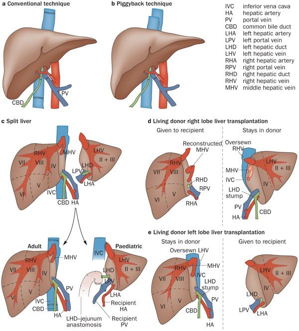 Liver transplant in Gurgaon 